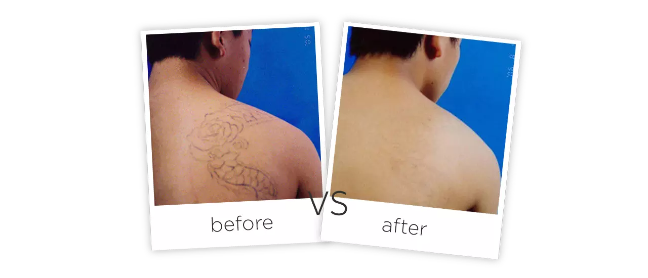 Nd Yag Лазер Удаления Татуировки Машины До и после сравнения