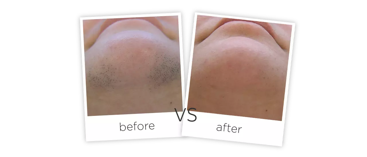 Контраст до и после лазерной эпиляции SHR на лице